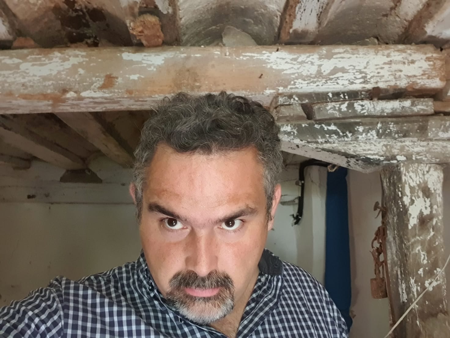 Caso ADF después del trasplante capilar