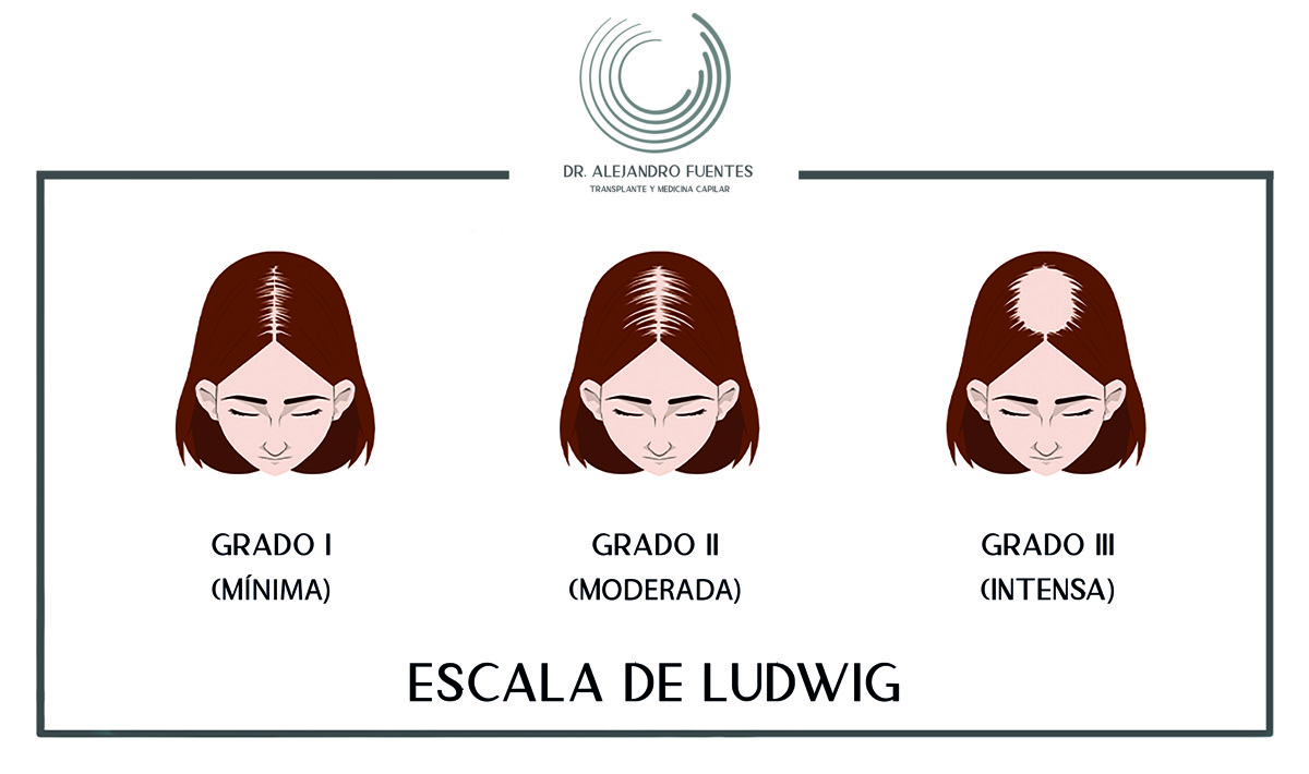 Escala de Ludwig: clasificación de la alopecia femenina
