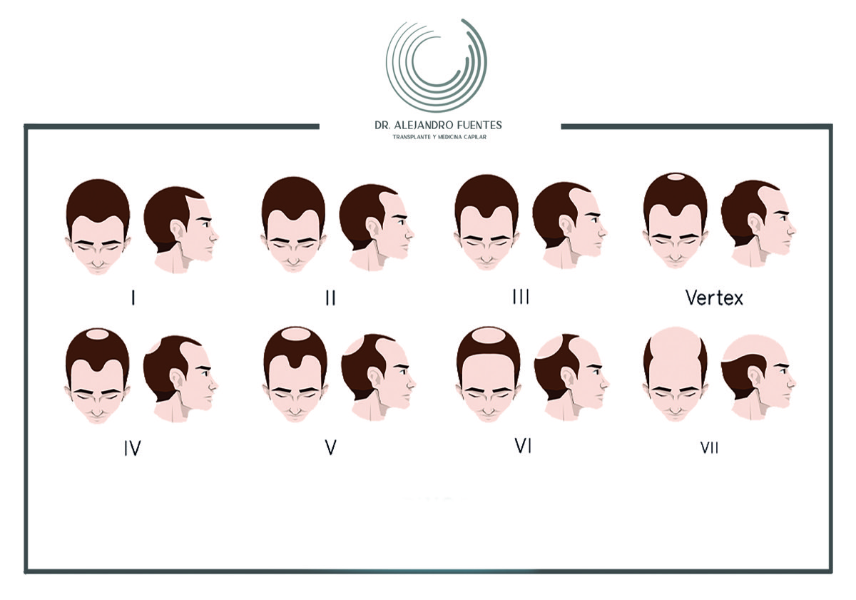 Escala de Norwood-Hamilton: clasificación de la alopecia masculina