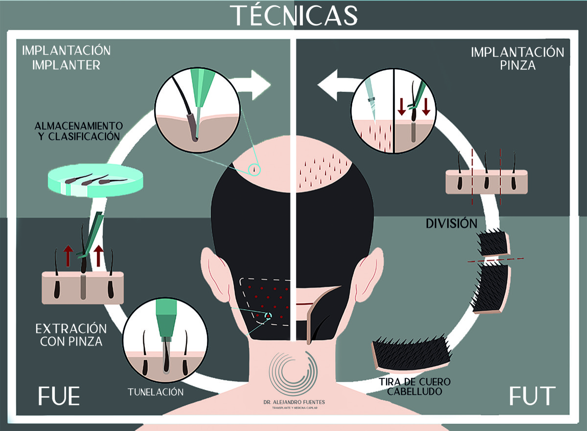 Infografía comparativa de las técnicas de trasplante capilar